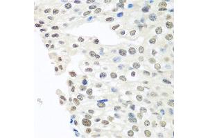 Immunohistochemistry of paraffin-embedded human prostate cancer using TARDBP antibody at dilution of 1:100 (40x lens). (TARDBP 抗体)