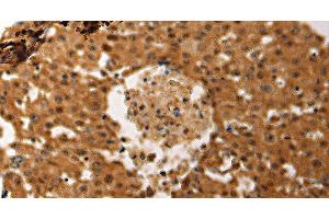 Immunohistochemistry of paraffin-embedded Human ovarian cancer tissue using JUND Polyclonal Antibody at dilution 1:60 (JunD 抗体)