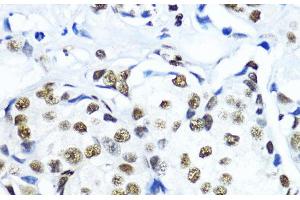 Immunohistochemistry of paraffin-embedded Human mammary cancer using TriMethyl-Histone H3-K79 Polyclonal Antibody at dilution of 1:200 (40x lens). (Histone 3 抗体  (3meLys79))
