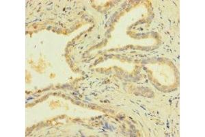 Immunohistochemistry of paraffin-embedded human prostate cancer using ABIN7166618 at dilution of 1:100 (PRY 抗体  (AA 13-147))