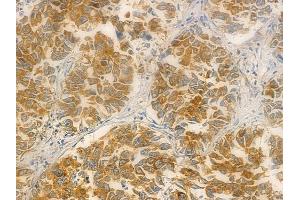 ABIN6257947 and ABIN6275876 at 1/100 staining human lung squamous cell carcinoma by IHC-P.