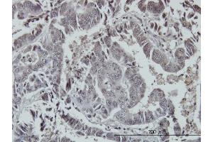 Immunoperoxidase of monoclonal antibody to FOXO3A on formalin-fixed paraffin-embedded human colon adenocarcinoma. (FOXO3 抗体  (AA 361-460))