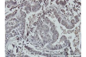 Immunoperoxidase of monoclonal antibody to FOXO3A on formalin-fixed paraffin-embedded human colon adenocarcinoma. (FOXO3 抗体  (AA 361-460))