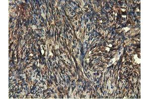 Immunohistochemical staining of paraffin-embedded Carcinoma of Human kidney tissue using anti-EPHX2 mouse monoclonal antibody. (EPHX2 抗体)