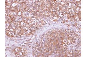 IHC-P Image Immunohistochemical analysis of paraffin-embedded human lung SCC, using ARHGAP1, antibody at 1:100 dilution.