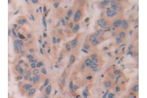 Detection of ATF4 in Human Breast cancer Tissue using Polyclonal Antibody to Activating Transcription Factor 4 (ATF4)