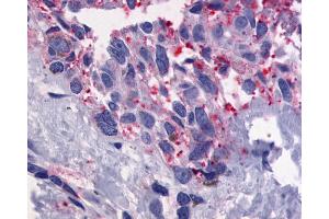 Anti-GPR56 antibody IHC of human Skin, Melanoma. (GPR56 抗体  (Cytoplasmic Domain))