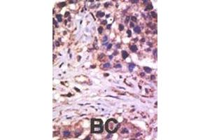 Formalin-fixed and paraffin-embedded human cancer tissue reacted with the primary antibody, which was peroxidase-conjugated to the secondary antibody, followed by AEC staining. (USP5 抗体  (N-Term))