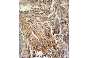 CSF2 antibody immunohistochemistry analysis in formalin fixed and paraffin embedded human lung carcinoma followed by peroxidase conjugation of the secondary antibody and DAB staining. (GM-CSF 抗体  (AA 59-85))