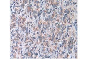 IHC-P analysis of Human Prostate Gland Cancer Tissue, with DAB staining. (SOD2 抗体  (AA 25-222))