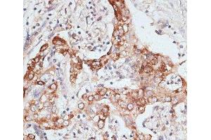 Immunohistochemistry of paraffin-embedded Human liver cancer using PIGR Polyclonal Antibody at dilution of 1:100 (40x lens). (PIGR 抗体)