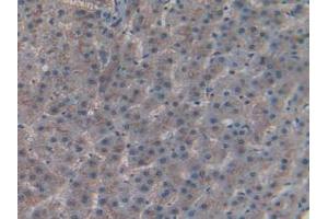 IHC-P analysis of Human Liver Cancer Tissue, with DAB staining. (CD55 抗体  (AA 35-285))
