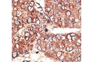 IHC analysis of FFPE human hepatocarcinoma tissue stained with the Megalin antibody (LRP2 抗体  (AA 4626-4655))