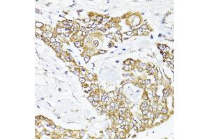 Immunohistochemistry of paraffin-embedded human colon carcinoma using MAVS antibody (ABIN6132297, ABIN6143583, ABIN6143584 and ABIN6221441) at dilution of 1:100 (40x lens). (MAVS 抗体  (AA 1-65))