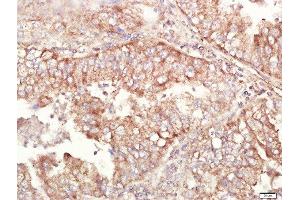 Paraformaldehyde-fixed, paraffin embedded human lung carcinoma tissue, Antigen retrieval by boiling in sodium citrate buffer(pH6) for 15min, Block endogenous peroxidase by 3% hydrogen peroxide for 30 minutes, Blocking buffer (normal goat serum) at 37°C for 20min, Antibody incubation with Rabbit Anti-ALDH1 Polyclonal Antibody, Unconjugated  at 1:400 overnight at 4°C, followed by a conjugated secondary and DAB staining (ALDH1A1 抗体  (AA 201-300))