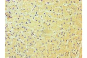 Immunohistochemistry of paraffin-embedded human liver cancer using ABIN7144985 at dilution of 1:100 (DDX3X 抗体  (AA 1-220))