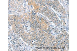 Immunohistochemistry of Human cervical cancer using SLIT2 Polyclonal Antibody at dilution of 1:30 (SLIT2 抗体)