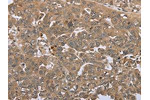 The image on the left is immunohistochemistry of paraffin-embedded Human ovarian cancer tissue using ABIN7192692(STMN2/STMN3/STMN4 Antibody) at dilution 1/45, on the right is treated with synthetic peptide. (STMN2/STMN3/STMN4 抗体)