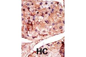 Formalin-fixed and paraffin-embedded human cancer tissue reacted with the primary antibody, which was peroxidase-conjugated to the secondary antibody, followed by DAB staining. (PFKFB2 抗体  (N-Term))