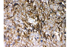 Anti- HLA-C Picoband antibody,IHC(P) IHC(P): Human Lung Cancer Tissue (HLA-C 抗体  (C-Term))