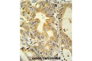 TNFRSF6B antibody (N-term) immunohistochemistry analysis in formalin fixed and paraffin embedded human colon carcinoma followed by peroxidase conjugation of the secondary antibody and DAB staining. (TNFRSF6B 抗体  (N-Term))