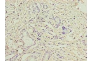 Immunohistochemistry of paraffin-embedded human pancreatic cancer using ABIN7158038 at dilution of 1:100 (LRG1 抗体  (AA 36-346))