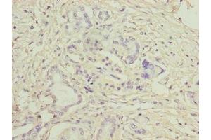 Immunohistochemistry of paraffin-embedded human pancreatic cancer using ABIN7158038 at dilution of 1:100