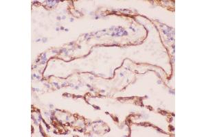 Anti-Collagen IV Picoband antibody,  IHC(P): Human Lung Cancer Tissue (COL4A1 抗体  (AA 1445-1669))