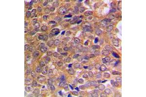 Immunohistochemical analysis of ABL1/2 (pY393/439) staining in human breast cancer formalin fixed paraffin embedded tissue section. (ABL1/2 抗体  (C-Term, pTyr393, pTyr439))