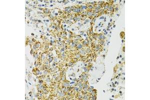 Immunohistochemistry of paraffin-embedded human lung cancer using HSPA9 antibody. (HSPA9 抗体  (AA 380-679))
