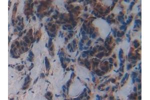 Detection of MPG in Human Breast cancer Tissue using Polyclonal Antibody to N-Methylpurine DNA Glycosylase (MPG) (MPG 抗体  (AA 221-296))