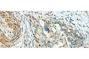 Immunohistochemistry of paraffin-embedded Human cervical cancer tissue using PLPPR5 Polyclonal Antibody at dilution of 1:120(x200) (LPPR5 抗体)