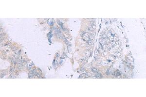 Immunohistochemistry of paraffin-embedded Human colorectal cancer tissue using GPC3 Polyclonal Antibody at dilution of 1:60(x200) (Glypican 3 抗体)