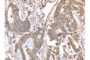 The image on the left is immunohistochemistry of paraffin-embedded Human colon cancer tissue using ABIN7128119(ABCB6 Antibody) at dilution 1/15, on the right is treated with fusion protein. (ABCB6 抗体)
