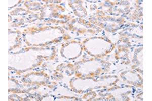 The image on the left is immunohistochemistry of paraffin-embedded Human thyroid cancer tissue using ABIN7189808(ANKRD26 Antibody) at dilution 1/25, on the right is treated with synthetic peptide. (ANKRD26 抗体)