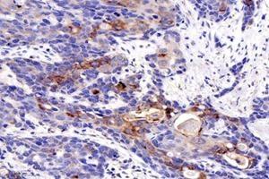 Immunohistochemistry analysis of paraffin-embedded human esophageal cancer using MIIP (ABIN7074626) at dilution of 1: 1200 (MIIP 抗体)