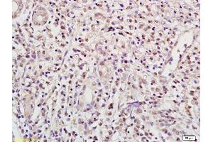 Formalin-fixed and paraffin embedded human gastric carcinoma labeled with Anti RBPJK/RBP-J Polyclonal Antibody, Unconjugated (ABIN872972) at 1:200 followed by conjugation to the secondary antibody and DAB staining (RBPJ 抗体  (AA 101-200))