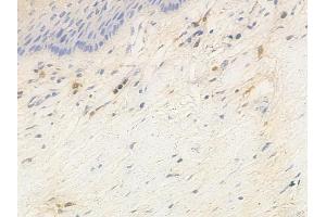 ABIN6263940 and ABIN6266908 at 1/100 staining human cervical carcinoma by IHC-P. (CDKN2C 抗体  (C-Term))