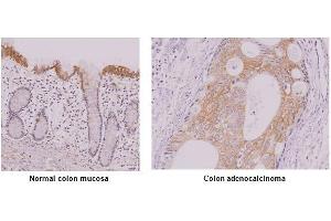 Paraffin embedded sections of normal colon mucosa and colon adenocalcinoma tissue were incubated with anti-human IRF-5 antibody (1:50) for 2 hours at room temperature. (IRF5 抗体  (AA 176-240))