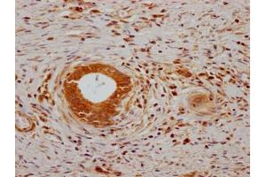 IHC image of ABIN7139767 diluted at 1:200 and staining in paraffin-embedded human gastric cancer performed on a Leica BondTM system. (CA9 抗体  (AA 38-414))