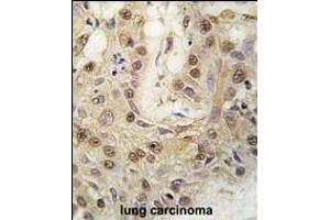 Formalin-fixed and paraffin-embedded human lung carcinoma tissue reacted with cGKII antibody (C-term) (ABIN392537 and ABIN2842089) , which was peroxidase-conjugated to the secondary antibody, followed by DAB staining. (PRKG2 抗体  (C-Term))