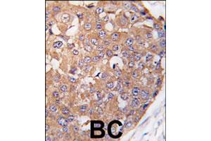Formalin-fixed and paraffin-embedded human breast carcinoma tissue reacted with PLK2 polyclonal antibody  , which was peroxidase-conjugated to the secondary antibody, followed by DAB staining. (PLK2 抗体  (C-Term))