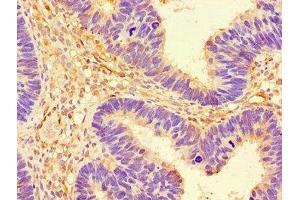 Immunohistochemistry of paraffin-embedded human ovarian cancer using ABIN7142675 at dilution of 1:100
