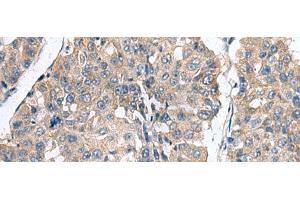 Immunohistochemistry of paraffin-embedded Human liver cancer tissue using CLEC1B Polyclonal Antibody at dilution of 1:60(x200)