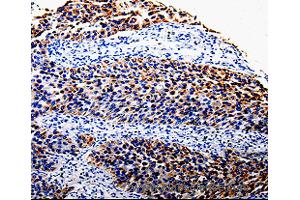 Immunohistochemistry of Human renal cancer using COX10 Polyclonal Antibody at dilution of 1:100 (COX10 抗体)