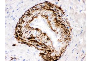 SMYD3 was detected in paraffin-embedded sections of human intestinal cancer tissues using rabbit anti- SMYD3 Antigen Affinity purified polyclonal antibody at 1 μg/mL. (SMYD3 抗体  (C-Term))