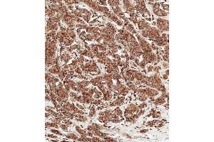 Immunohistochemical analysis of paraffin-embedded human breast carcinoma tissue using (ABIN6242215 and ABIN6577457) performed on the Leica® BOND RXm. (Cathepsin D 抗体  (AA 1-412))