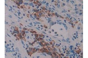 Detection of LAT2 in Human Lung cancer Tissue using Polyclonal Antibody to Linker For Activation Of T-Cells Family, Member 2 (LAT2) (LAT2 抗体  (AA 30-209))