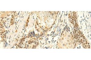 Immunohistochemistry of paraffin-embedded Human esophagus cancer tissue using HMBOX1 Polyclonal Antibody at dilution of 1:50(x200) (HMBOX1 抗体)