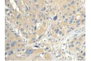 IHC-P analysis of Human Esophagus Cancer Tissue, with DAB staining. (CALML3 抗体  (AA 1-149))